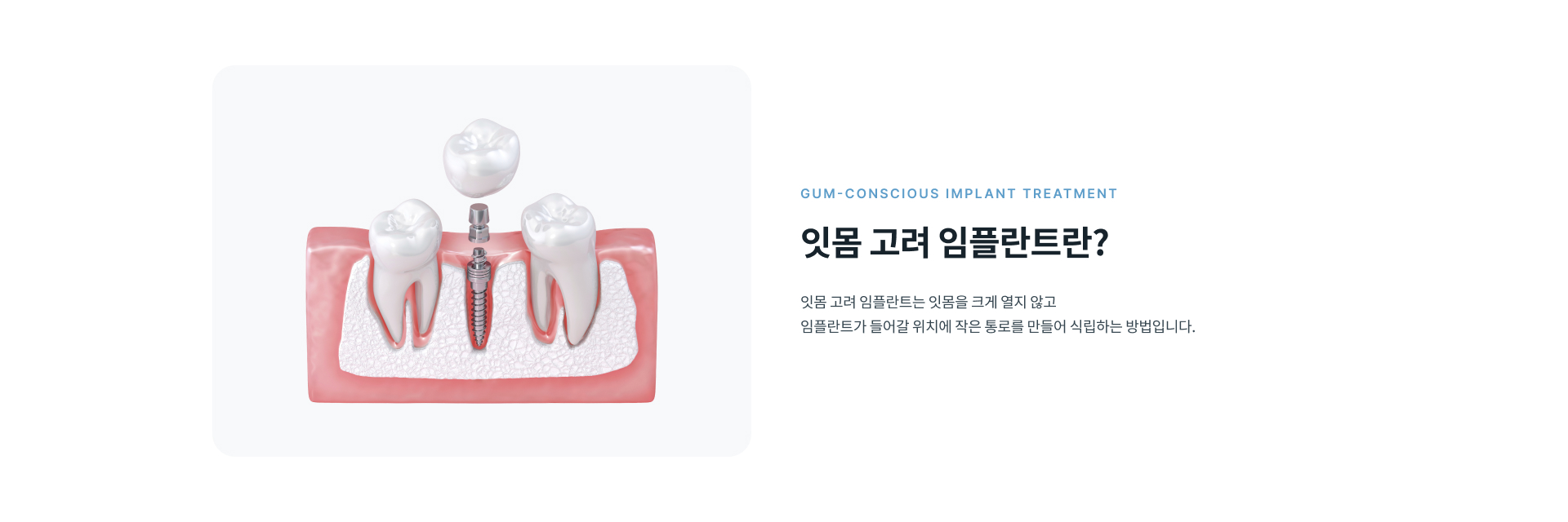 잇몸을 크게 열지 않고 작은 통로를 통해 임플란트를 식립하는 잇몸 고려 임플란트 치료