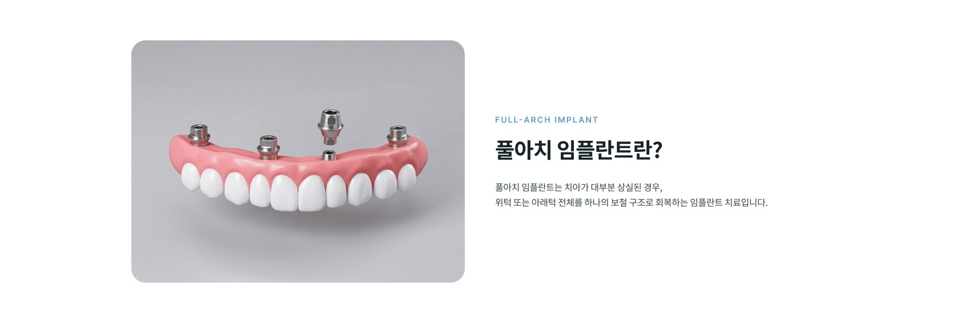 치아가 대부분 상실된 경우 위턱 또는 아래턱 전체를 하나의 보철 구조로 회복하는 풀아치 임플란트