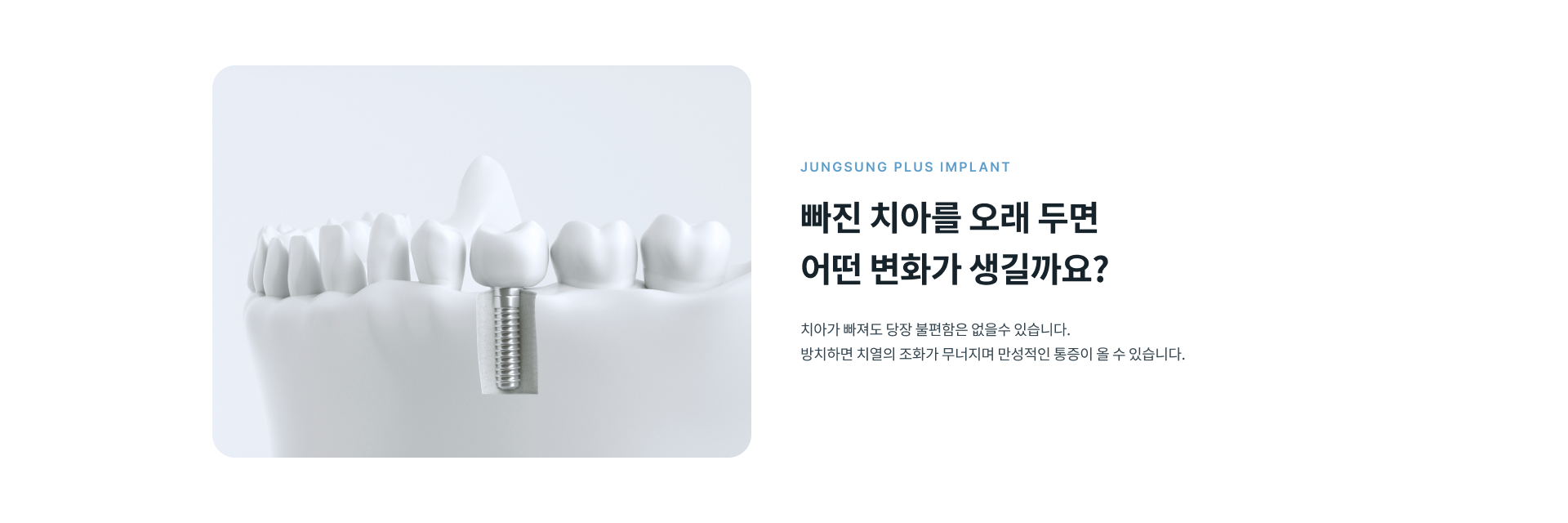 빠진 치아를 오래 방치했을 때 발생할 수 있는 치열 변화와 임플란트 치료 안내