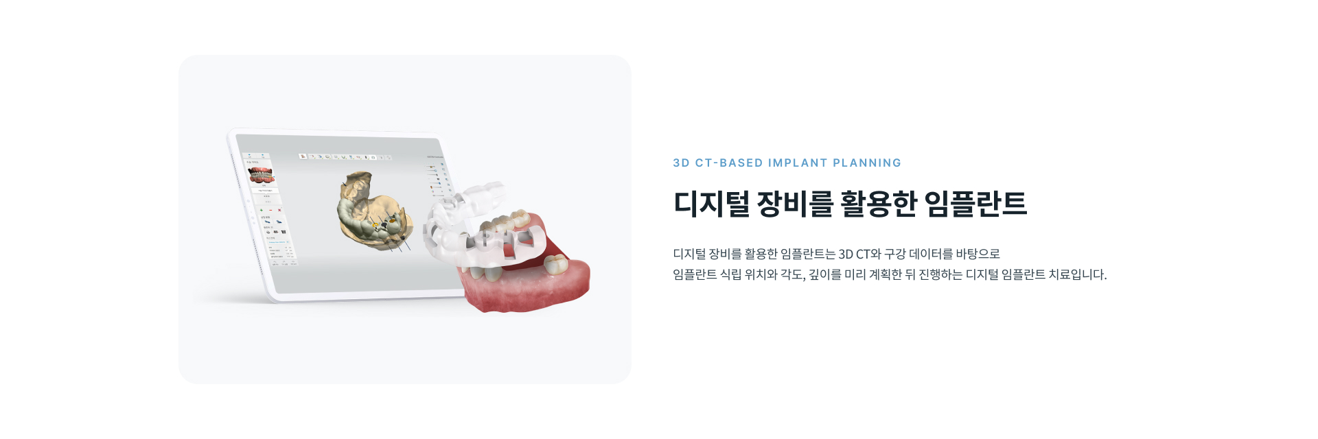 정성플러스치과 디지털 장비를 활용한 임플란트의 3D 정밀 진단과 디지털 식립 계획 및 주요 특징