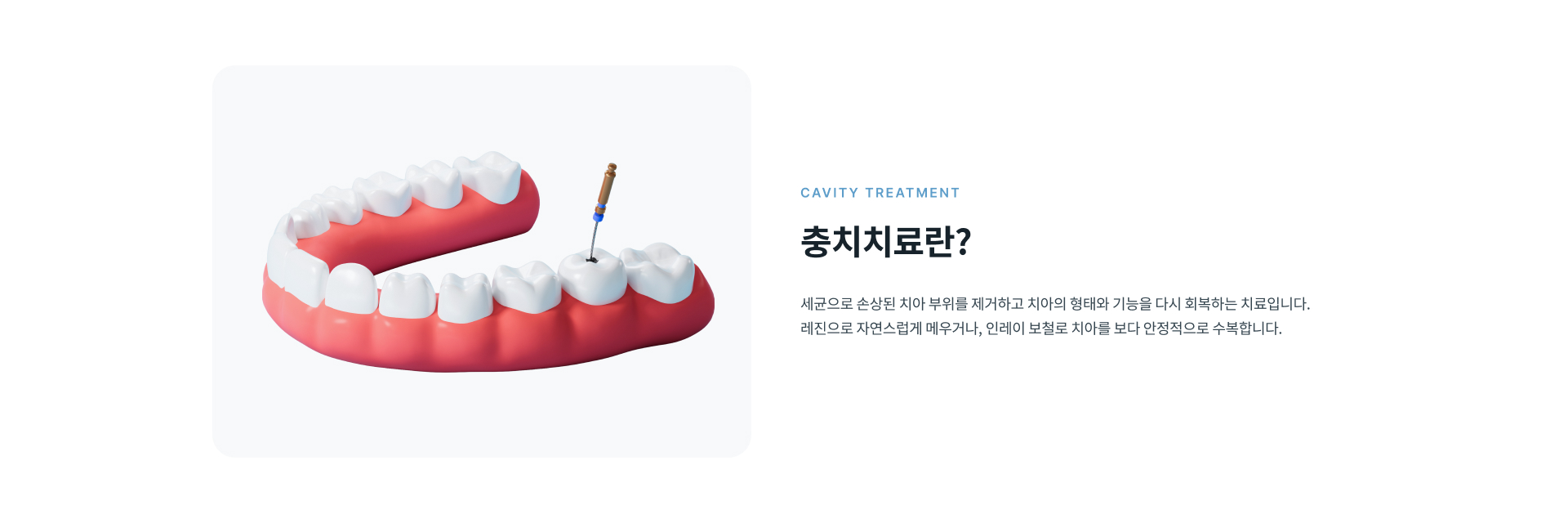 세균으로 손상된 치아를 제거하고 레진 또는 인레이 보철로 치아의 형태와 기능을 회복하는 충치치료