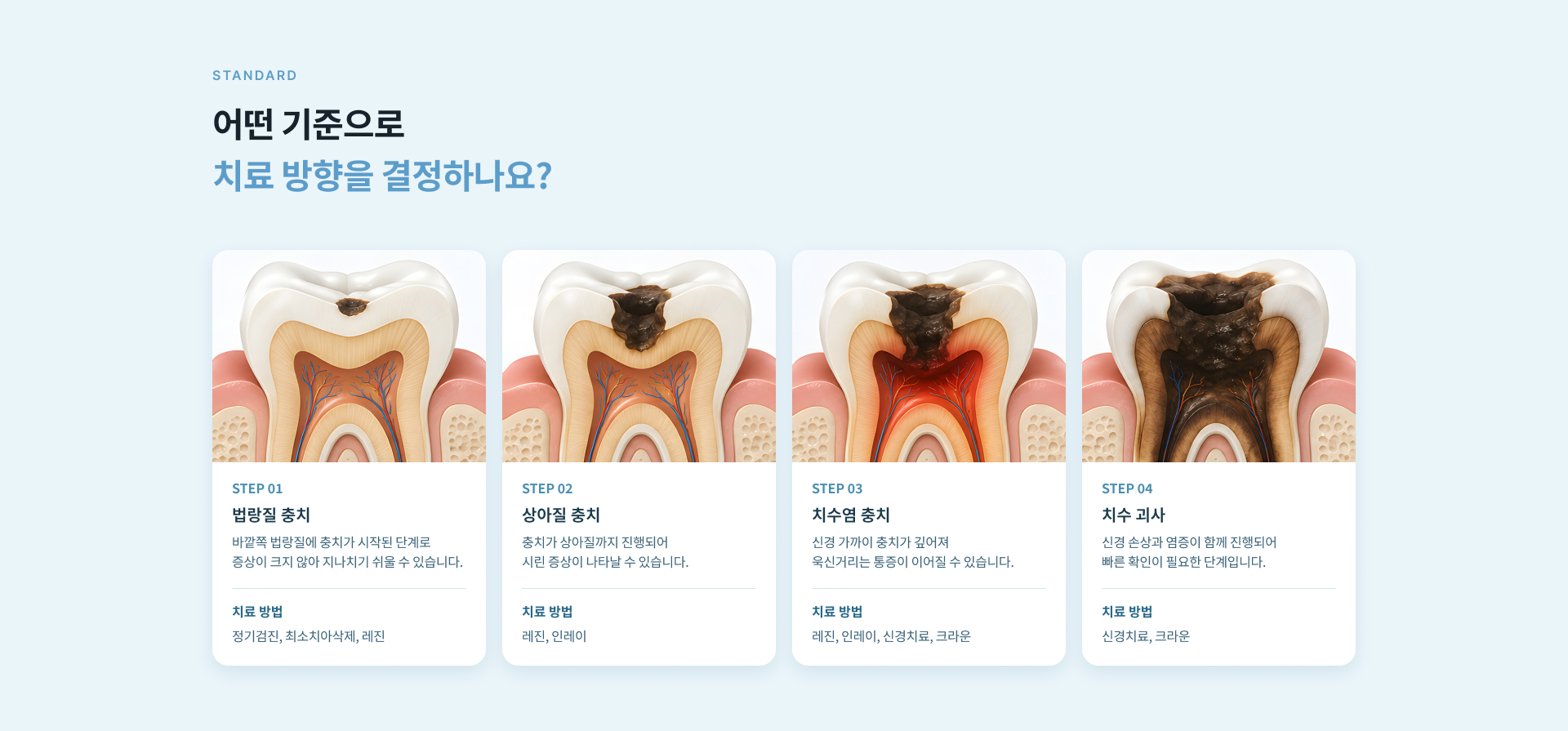 법랑질 충치, 상아질 충치, 치수염 충치, 치수 괴사 단계에 따른 충치 진행 정도와 치료 방법 안내