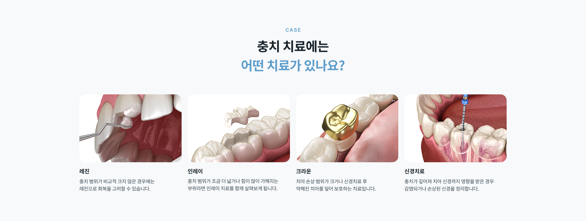 레진, 인레이, 크라운, 신경치료 등 충치 범위와 치아 손상 정도에 따른 충치치료 방법
