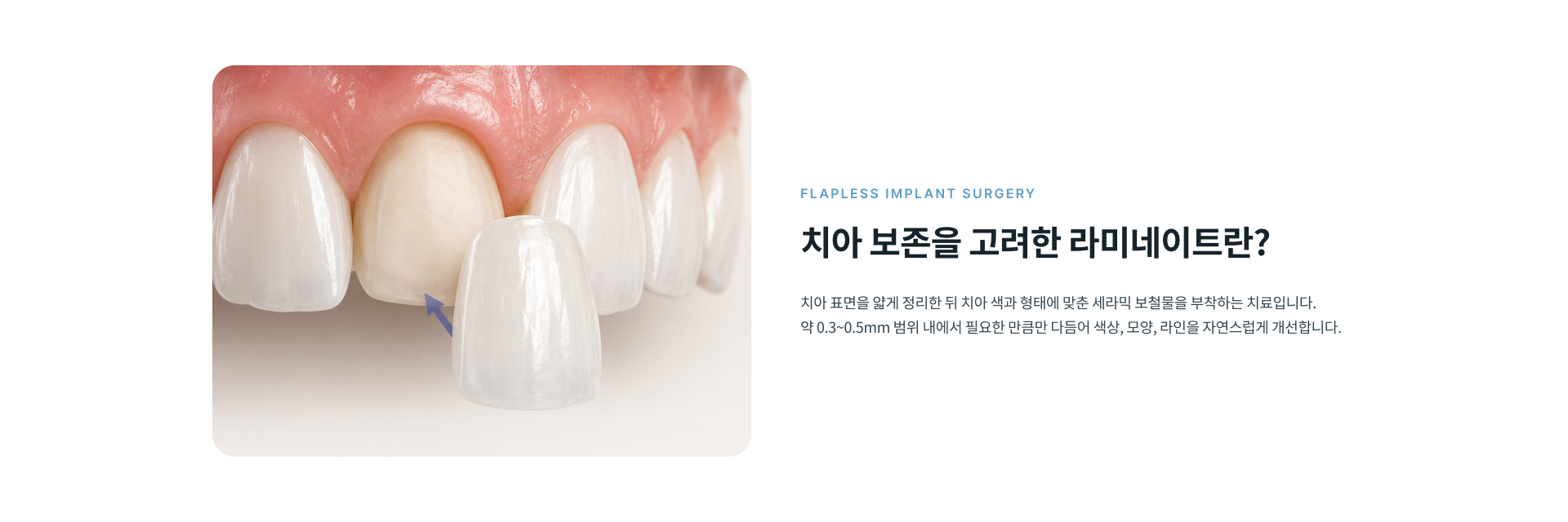 치아 표면을 필요한 만큼만 다듬어 자연치아 보존과 심미 개선을 함께 고려하는 라미네이트 치료