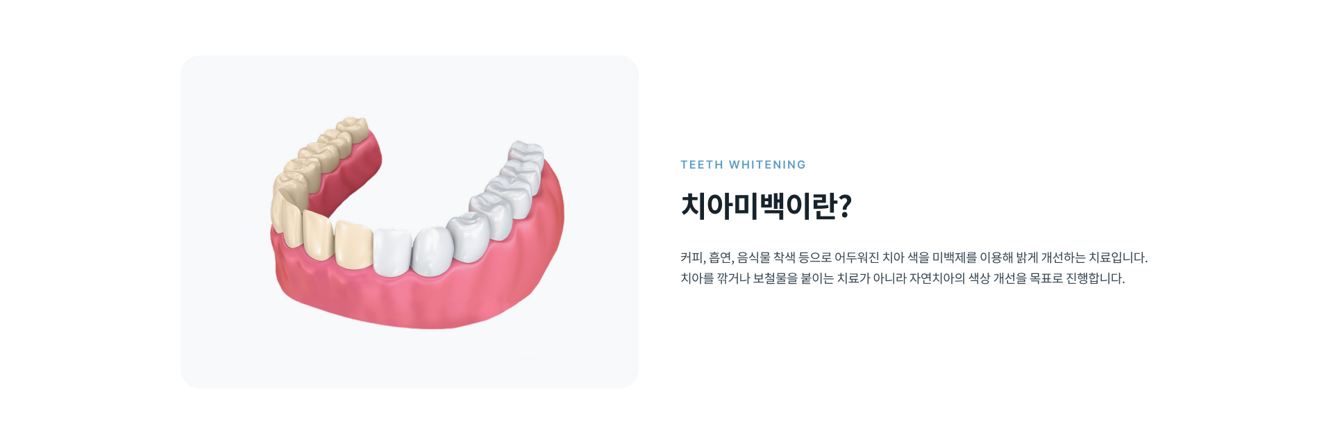 커피, 흡연, 음식물 착색 등으로 어두워진 자연치아의 색상을 밝게 개선하는 치아미백 치료