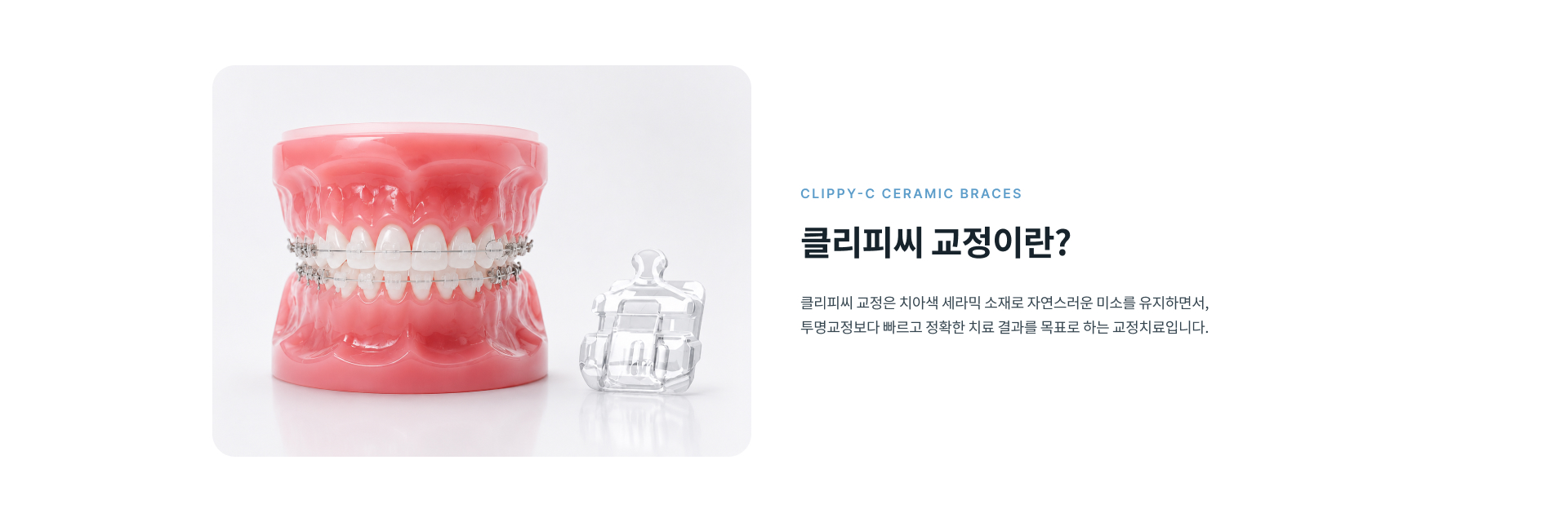 치아색 세라믹 브라켓과 자가결찰 방식을 활용해 심미성과 치아 이동을 고려하는 클리피씨 치아교정