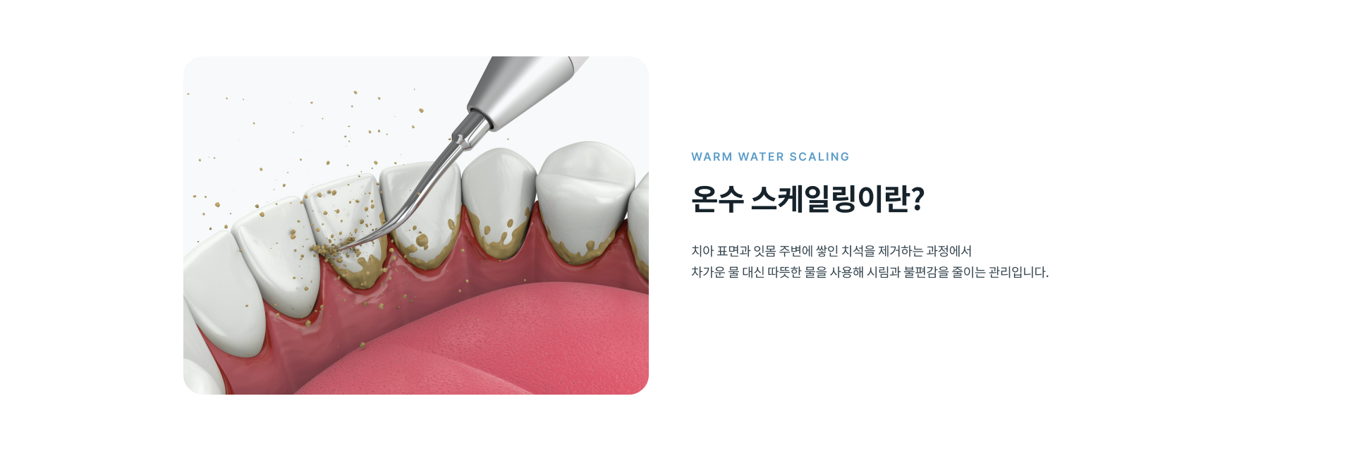 온수 스케일링은 차가운 물 대신 따뜻한 물을 활용해 시림 부담을 줄이면서 치아 표면과 잇몸 주변에 쌓인 치석을 제거하는 스케일링입니다