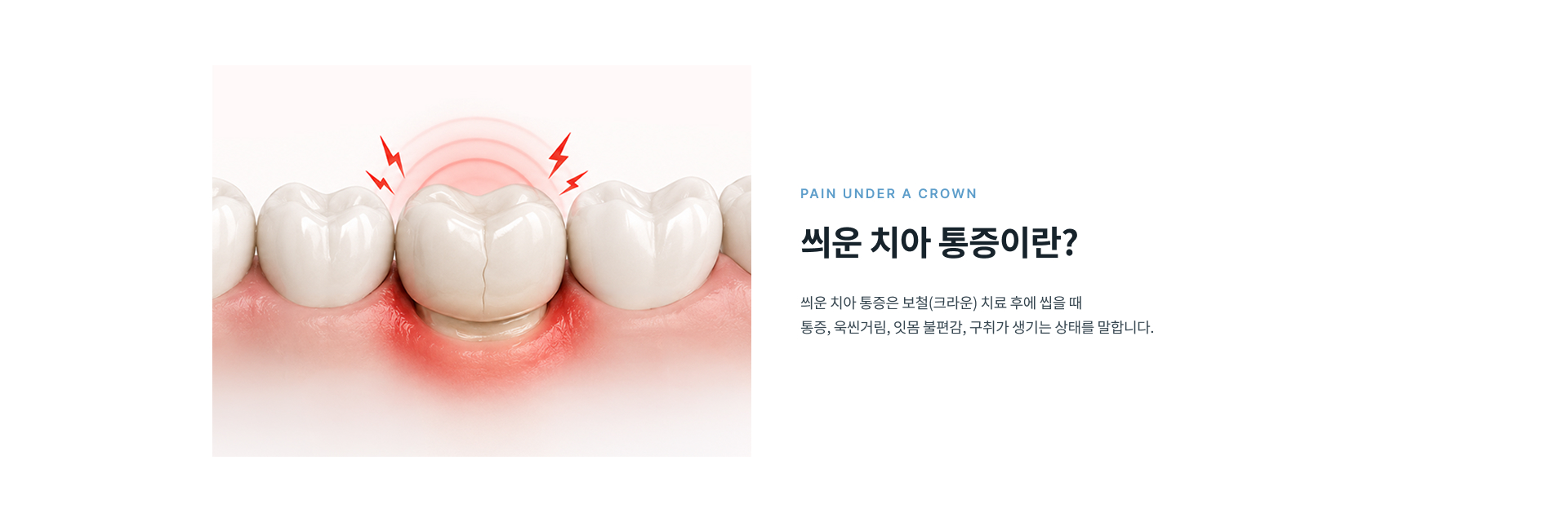 보철 치료 후 씹을 때 통증이나 욱신거림, 잇몸 불편감이 나타나는 씌운 치아 통증의 원인과 상태를 확인하는 재치료