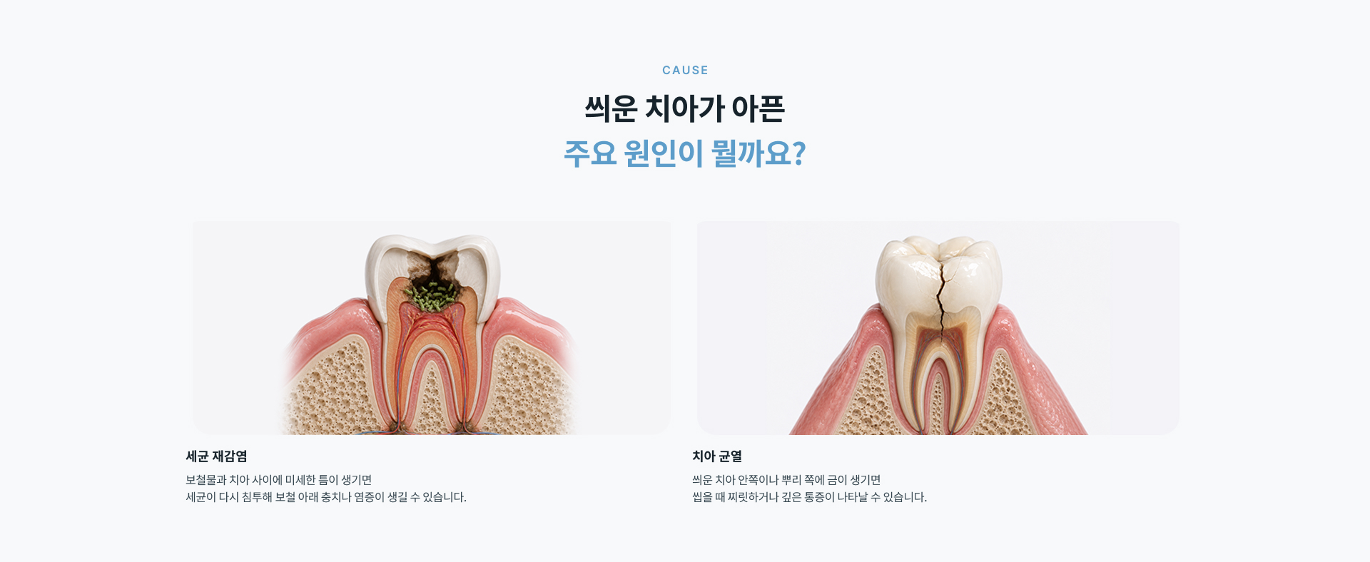 씌운 치아 통증의 주요 원인인 보철물 아래 세균 재감염과 치아 균열을 확인하고 자연치아 보존 가능성을 살펴보는 진료