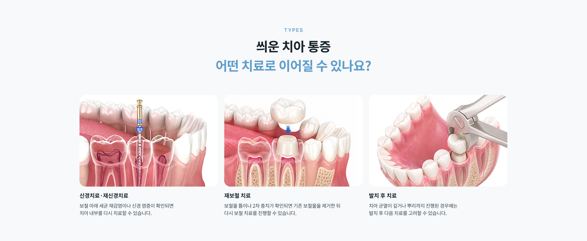 씌운 치아도 충치 재발과 보철물 아래 염증, 치아 균열 등이 발생할 수 있어 원인을 다시 확인하는 재치료 진료