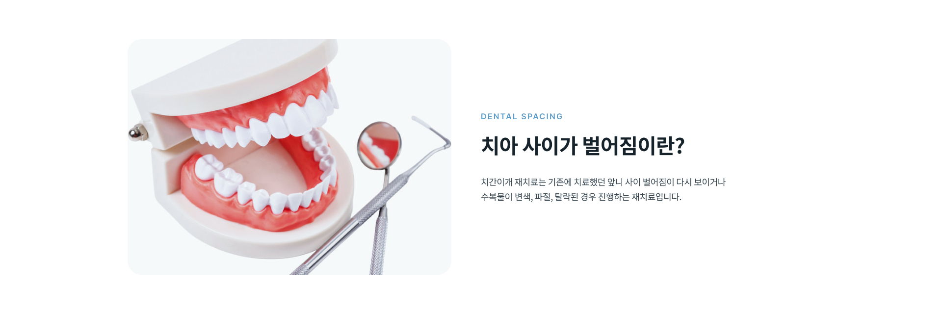 치아 사이가 다시 벌어져 보이는 정도와 기존 레진이나 라미네이트 수복물의 상태, 앞니 비율과 잇몸 라인을 확인해 치간이개 재치료 방법을 결정합니다