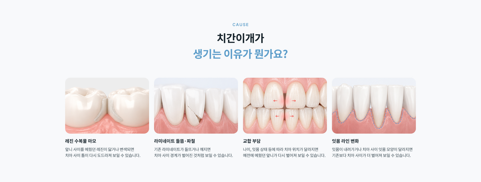 치간이개 재치료는 기존 수복물과 치아 상태에 따라 레진 재수복, 라미네이트 재치료 또는 기존 수복물 교체 등의 방법으로 진행할 수 있습니다