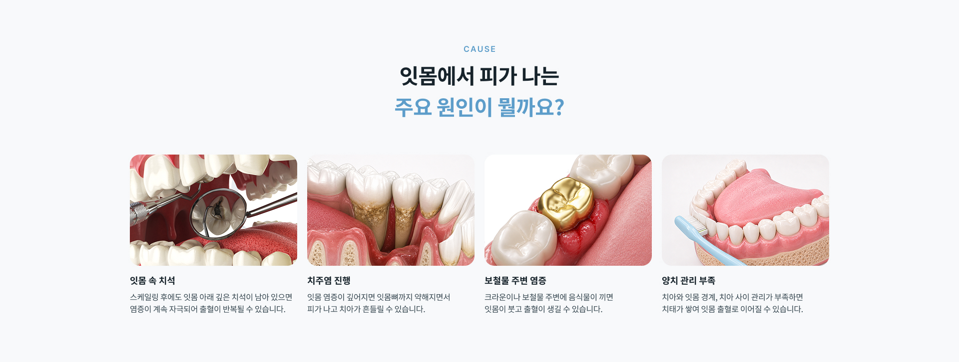 잇몸 출혈의 원인이 될 수 있는 잇몸 속 치석과 치주염 진행 정도를 확인하고 상태에 맞는 잇몸 치료 방향을 안내하는 과정