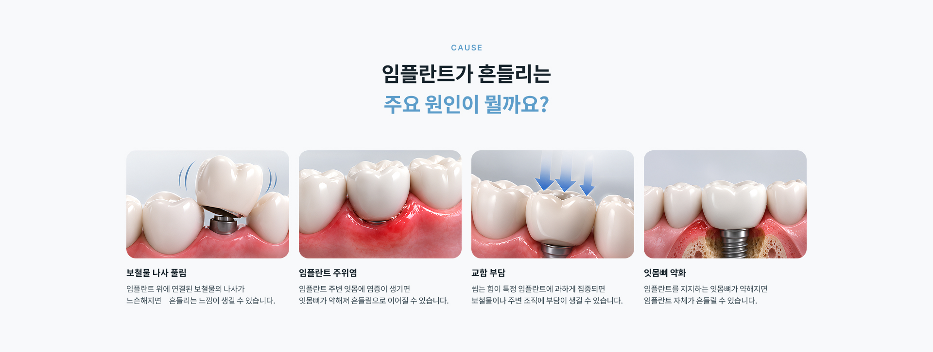 임플란트 흔들림의 원인에 따라 보철물 조정과 나사 조임, 임플란트 주위염 치료 또는 임플란트 재수술 등 필요한 재치료를 진행합니다