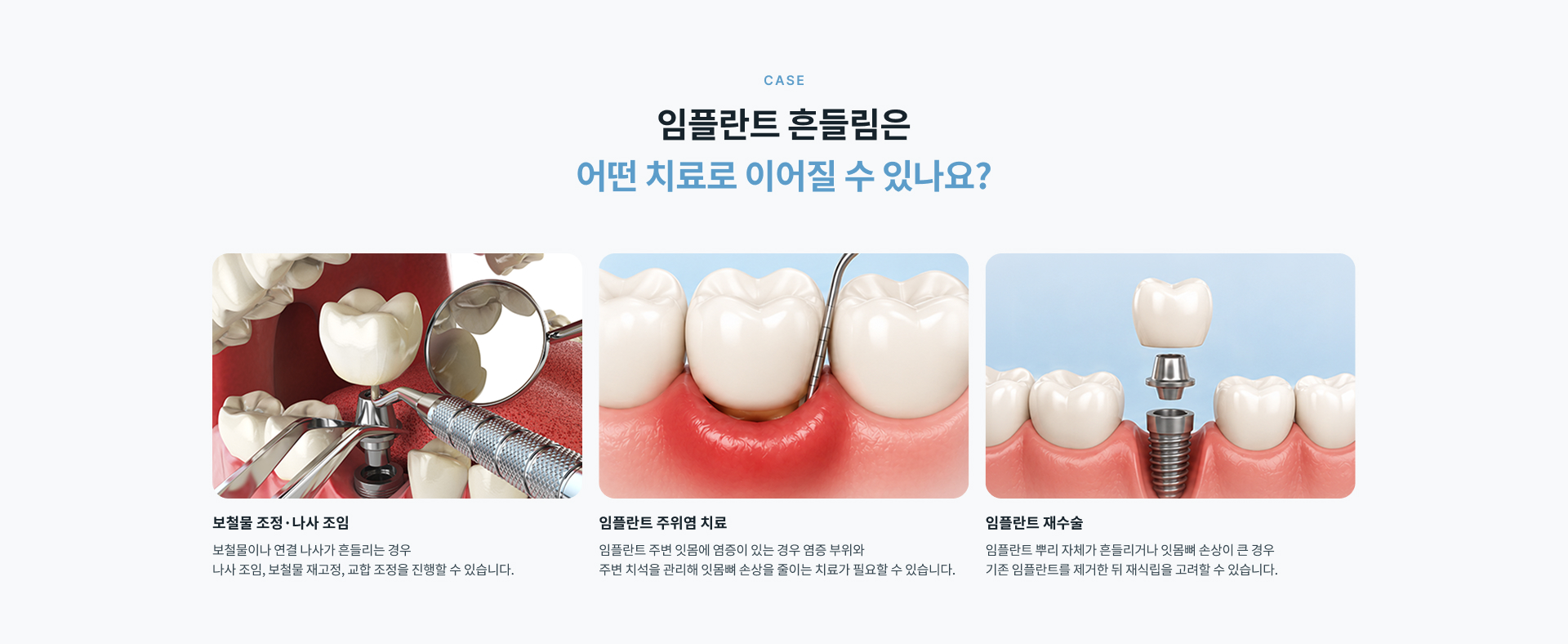 임플란트 보철물이나 연결 나사, 주변 잇몸에 문제가 생겨 씹을 때 움직이는 느낌이나 불편감이 나타나는 임플란트 흔들림