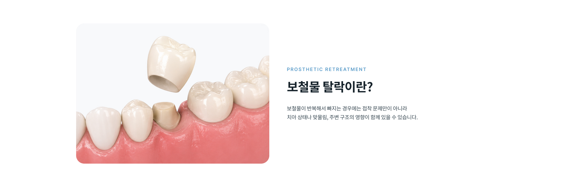 반복적으로 보철물이 빠지는 경우 보철물과 치아 상태, 교합과 주변 구조를 함께 확인해 탈락 원인을 살펴보는 보철 재치료
