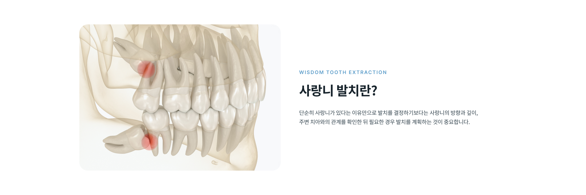 치과 치료에 대한 긴장과 두려움이 크다면 환자의 상태와 치료 난이도를 고려해 의식하진정 사랑니 발치를 진행할 수 있으며 치료 과정 중 환자 상태를 지속적으로 확인합니다